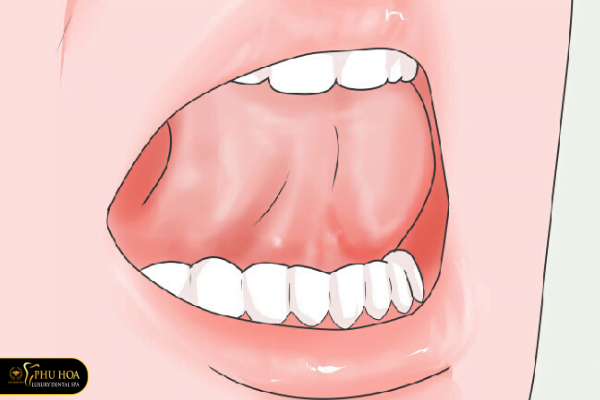 Cách làm đều răng không cần niềng dùng lưỡi đẩy