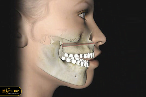 Cách làm đều răng không niềng phẫu thuật hàm