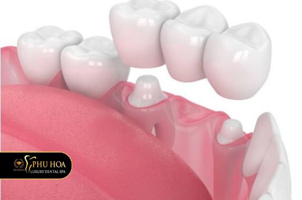 Trồng răng hàm dưới giá bao nhiêu bằng trồng răng bắc cầu 