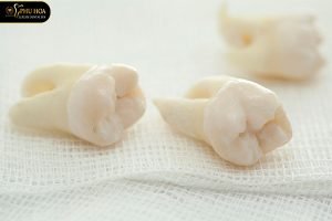 trồng răng số 7