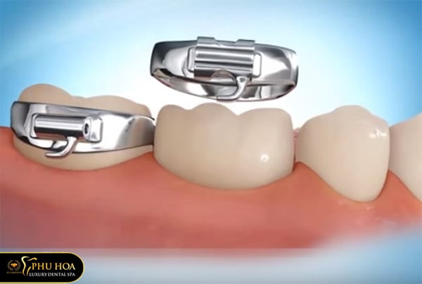 gắn khâu niềng răng