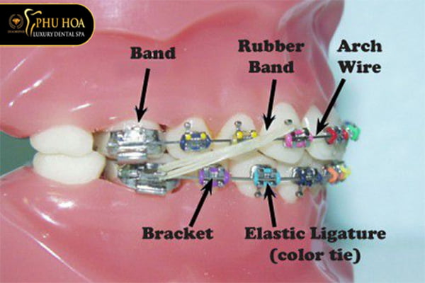 gắn thun niềng răng