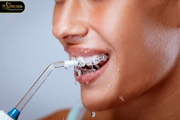 niềng răng ăn cháo bao lâu