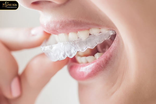 niềng răng bao lâu thì ăn được cơm