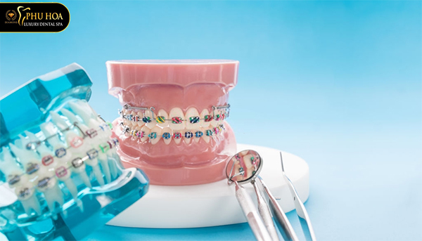 niềng răng có nhổ răng