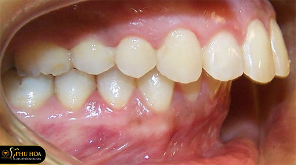 niềng răng có nhổ răng không