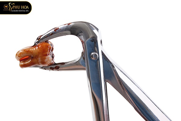 niềng răng có phải nhổ không