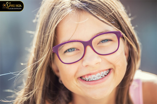 niềng răng không nhổ