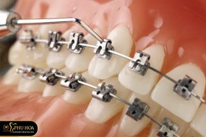 niềng răng mọc lệch