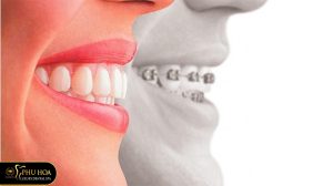 niềng răng nhổ răng