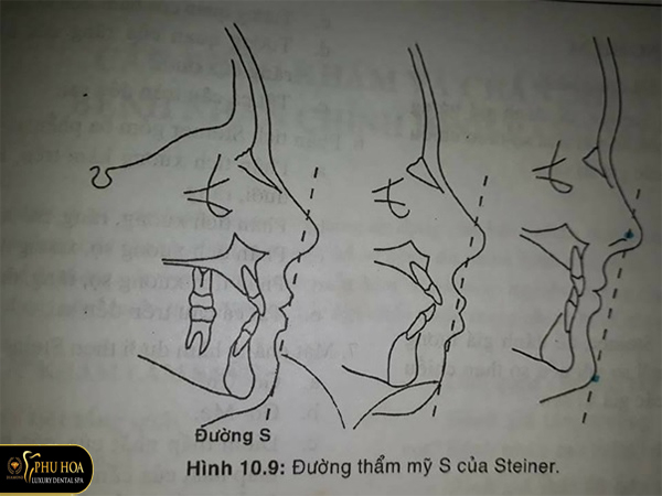 niềng răng phải nhổ răng