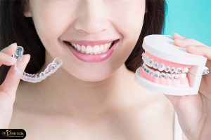 niềng răng xong bị móm