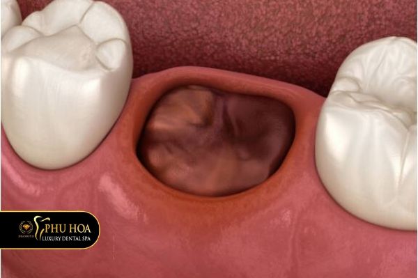 Trồng răng 2 hàm giá bao nhiêu phát âm sai 