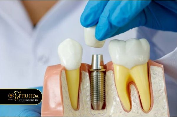 Trồng răng 2 hàm giá bao nhiêu phương pháp điều trị 