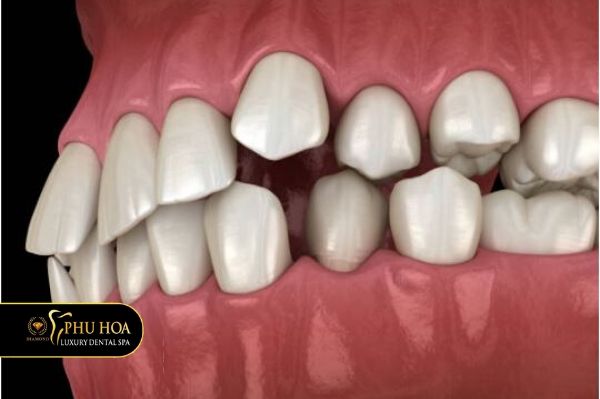 Trồng răng 2 hàm gia bao nhiêu răng lệch lạc 