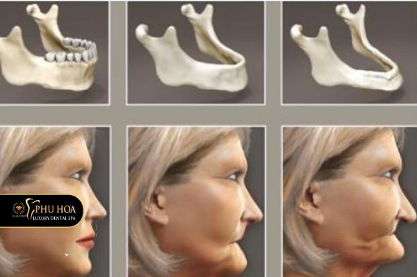 Trồng răng 2 hàm giá bao nhiêu tiêu xương hàm 